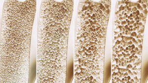 Olej CBD w leczeniu chorób układu kostnego - Osteoporoza