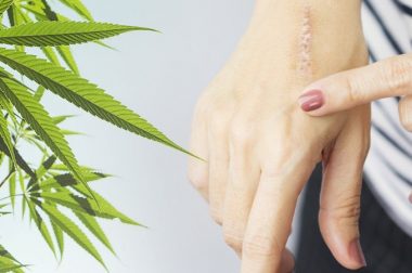 Olejek CBD jako naturalny środek na blizny i trądzik