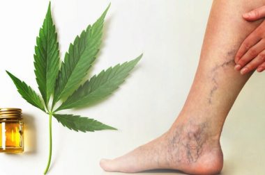 Konopie na żylaki? Skutecznie złagodzą objawy